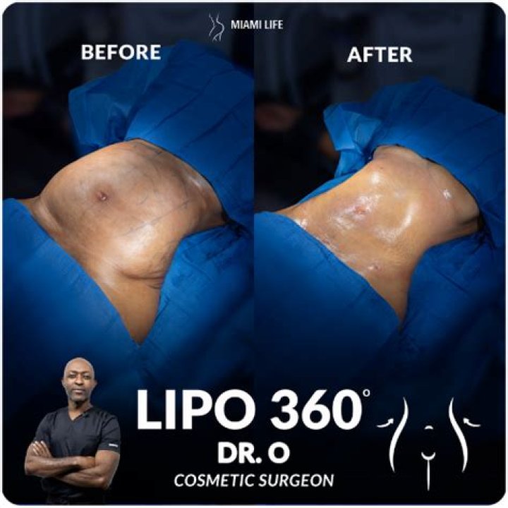 Chrissy Teigen Got Armpit Liposuction — What Is It & Should You Try It?